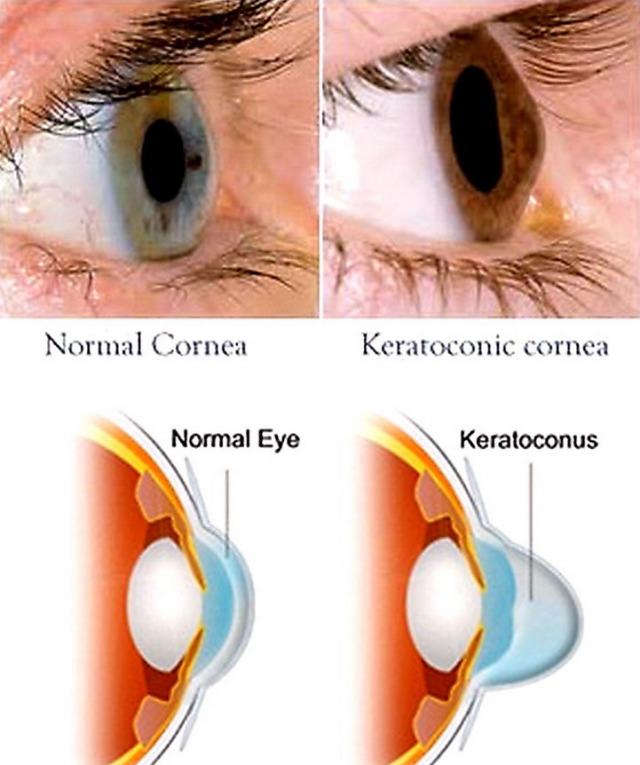 Risultato immagini per cheratocono
