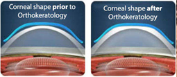 corneal_shapes